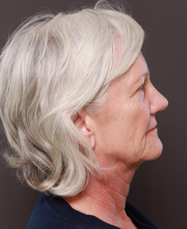 Before Image: Facelift & Lower Blepharoplasty by Dr. Thompson, Contour TRL by Dr. Manning - right-side