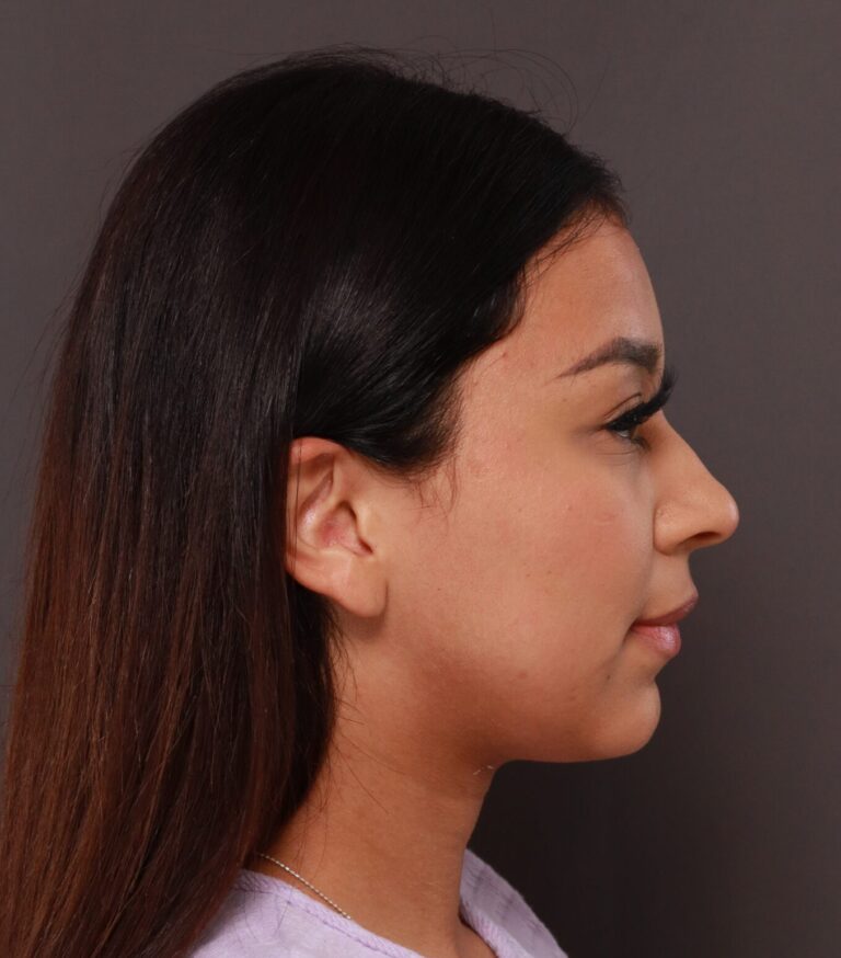 Before Image: Rhinoplasty by Dr. Manning - right-side