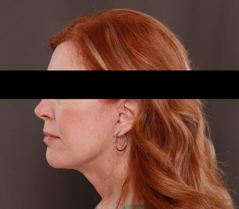 After Image: Facelift by Dr. Henstrom - left-side