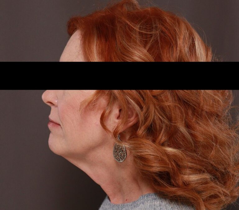 Before Image: Facelift by Dr. Henstrom - left-side