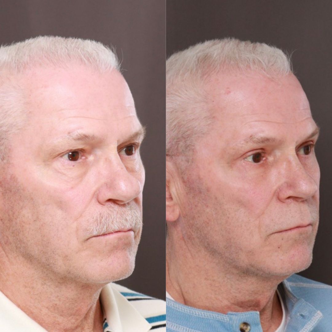 lower blepharoplasty