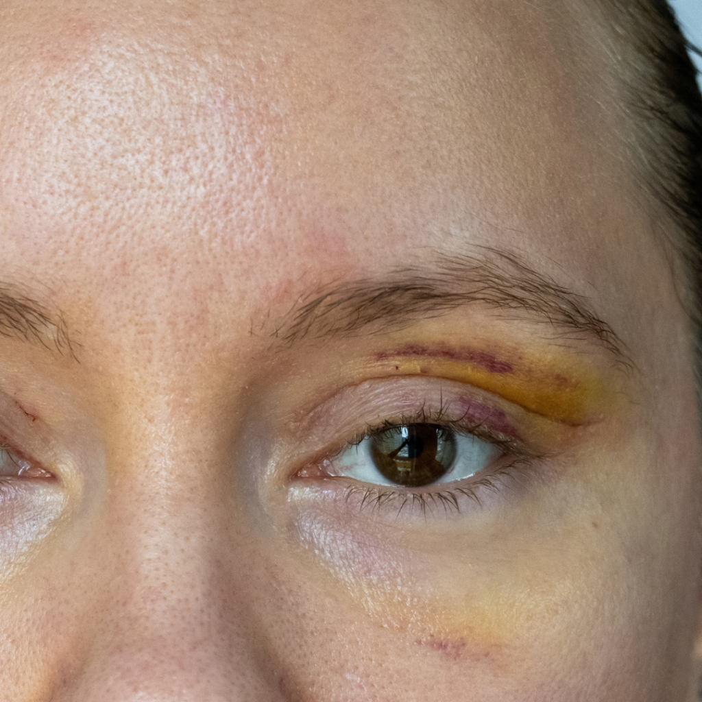 blepharoplasty recovery