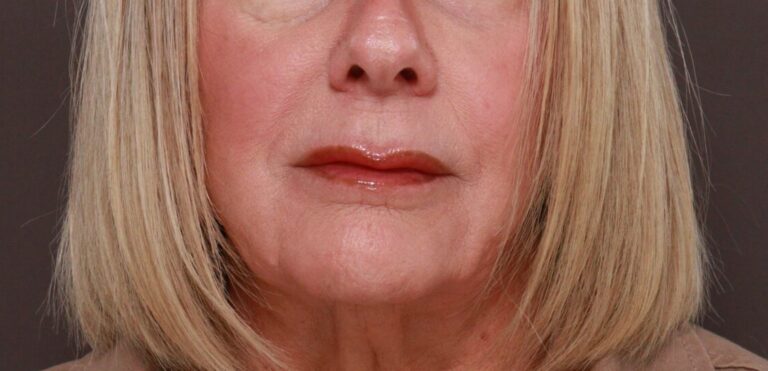 Before Image: Lip Lift by Dr. Henstrom - front