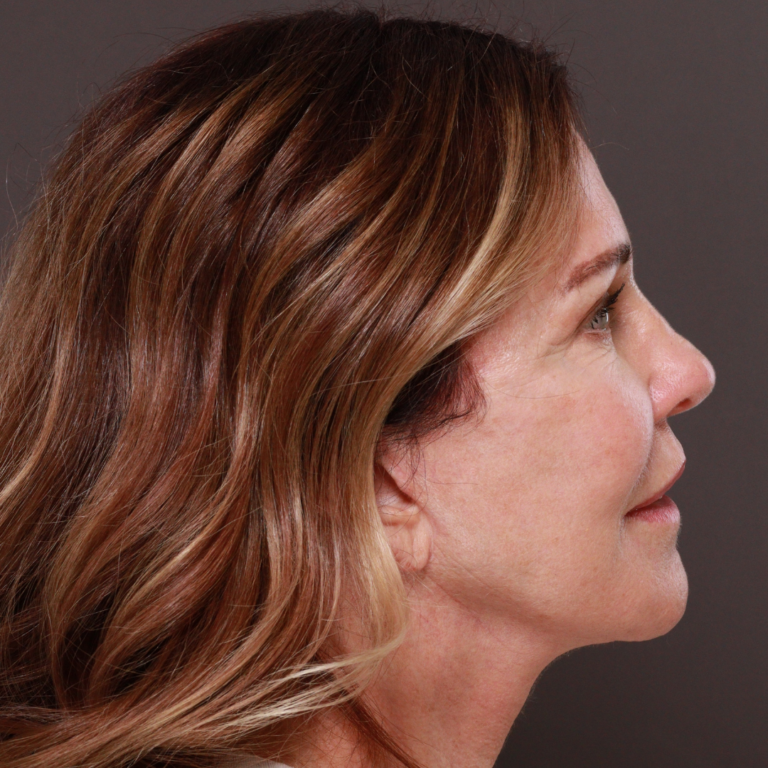 After Image: Revision Facelift by Dr. Henstrom - left-side