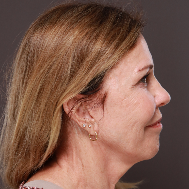 Before Image: Revision Facelift by Dr. Henstrom - left-side