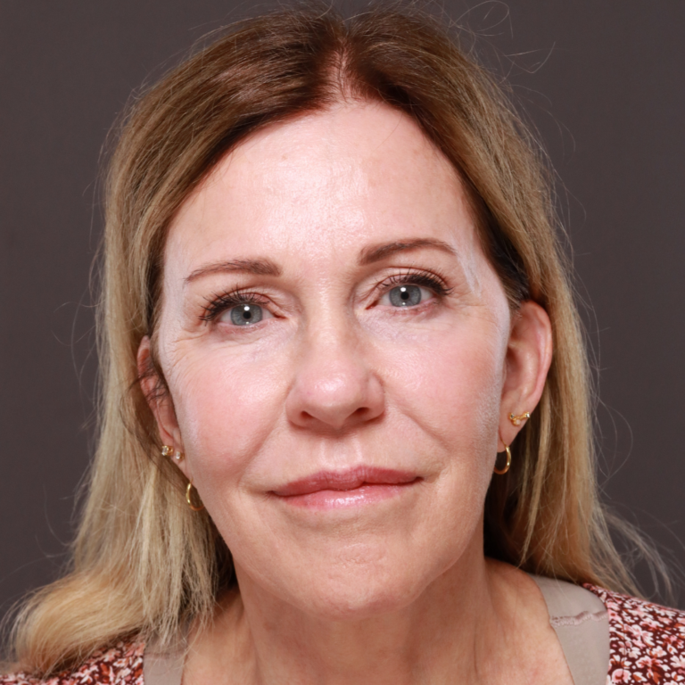 Before Image: Revision Facelift by Dr. Henstrom - front