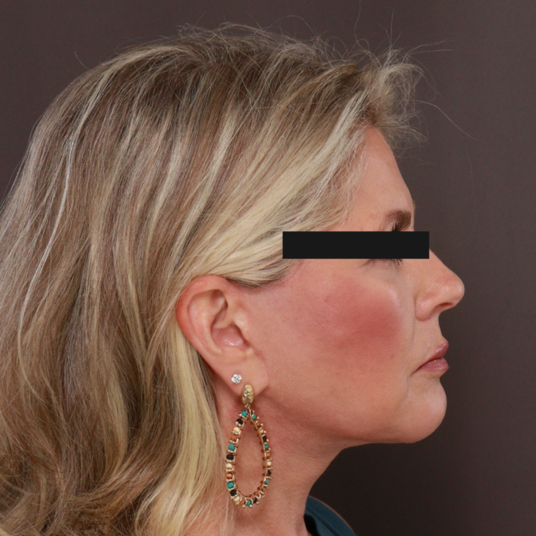 After Image: Revision Facelift & Earlobe Repair by Dr. Thompson - right-side